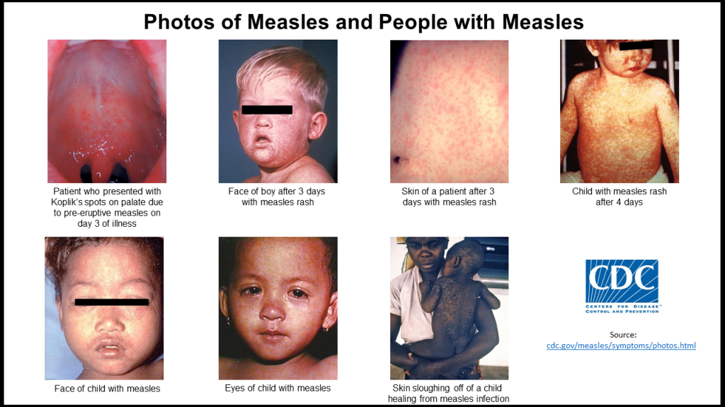 Measles Lake County General Health