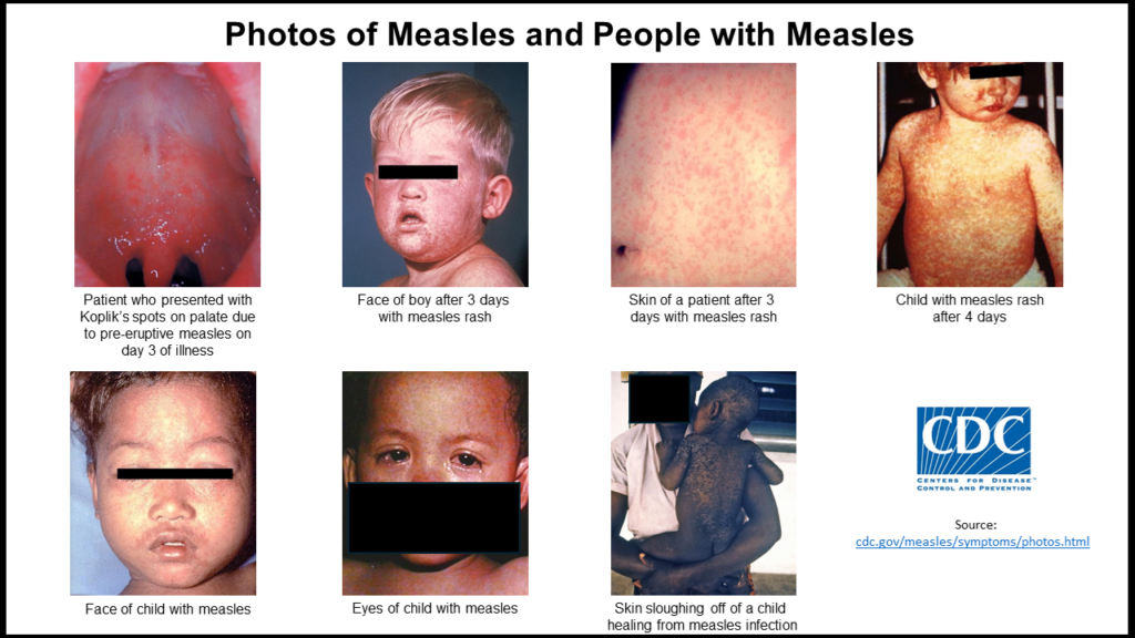 Rubeola Measles Treatment